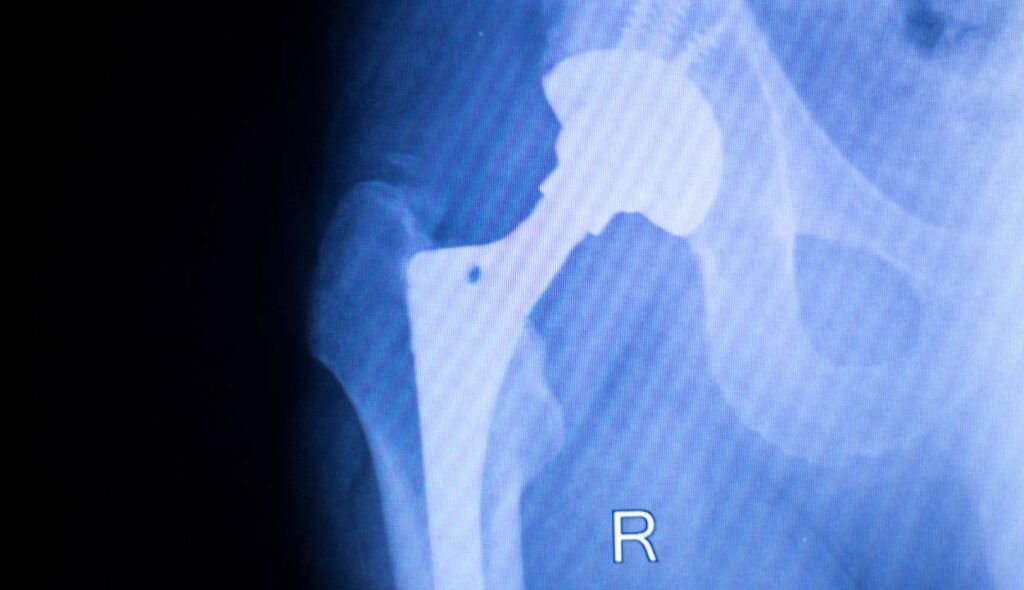 Joint Replacement Surgery in Nagpur
